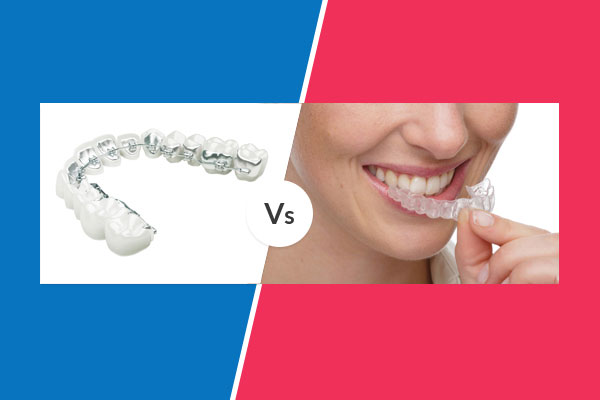 invisalign vs lingual braces