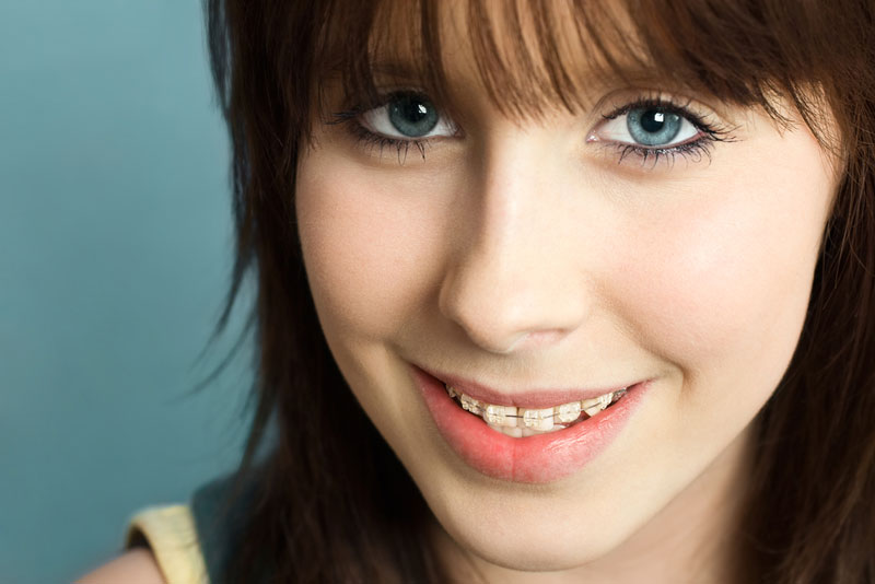 teen braces